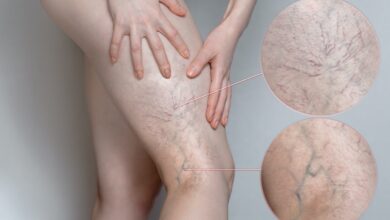 What are the Main Causes of Spider Veins?