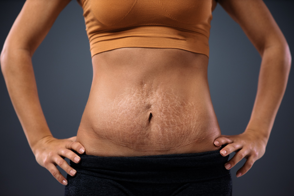 A Comprehensive Guide on Bellevue Tummy Tuck
