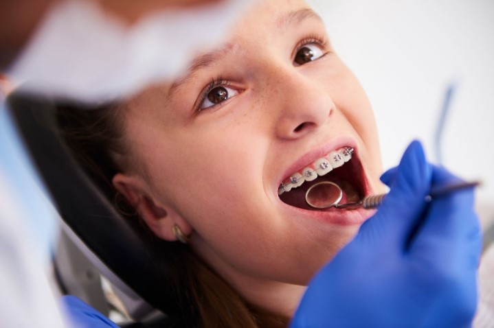 Orthodontic Treatment for Children: Early Intervention and Benefits