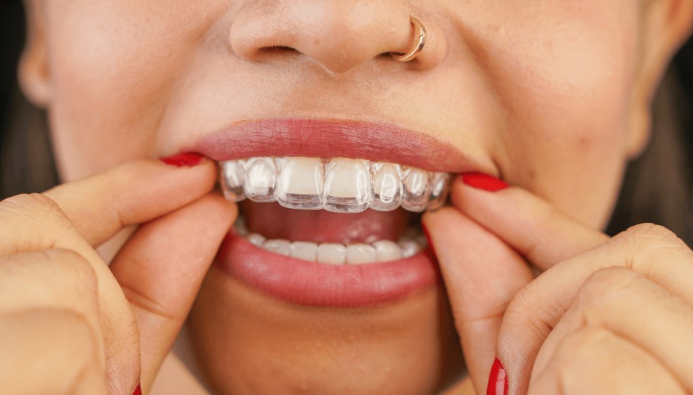 The Importance Of Consistency When Wearing Clearn Aligners