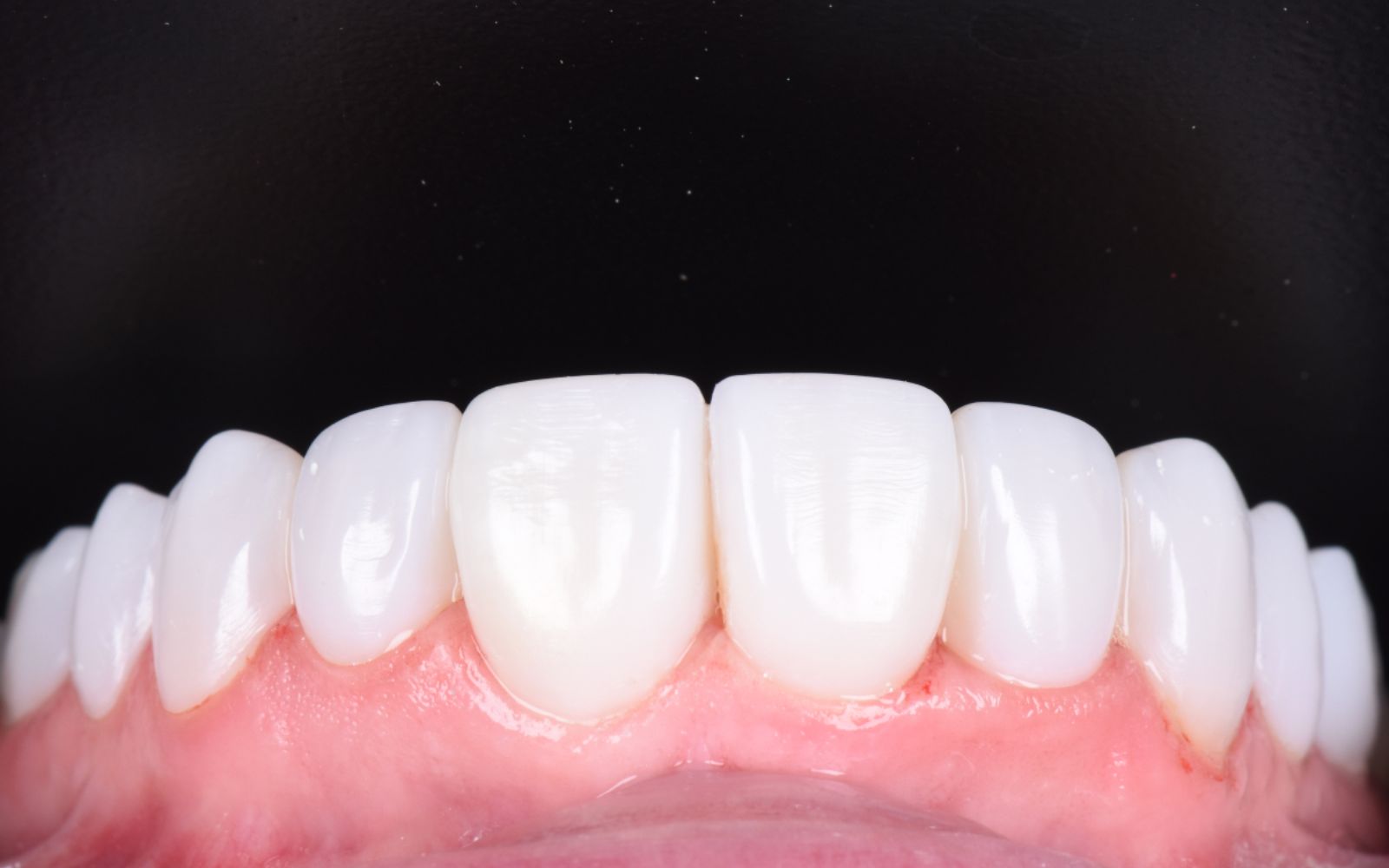 Why Composite Fillings Are A Popular Cosmetic Option