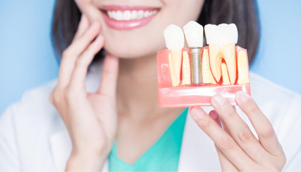 3 Major Differences Between Implants And Dentures