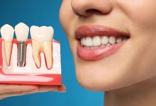 5 Benefits Of Dental Implants In Restorative Dentistry
