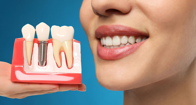 5 Benefits Of Dental Implants In Restorative Dentistry