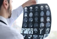 Understanding Brain Injuries After Serious Accidents and Their Lasting Effects